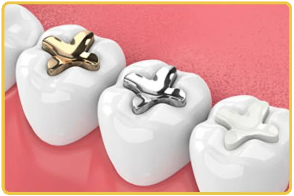 Dental Fillings