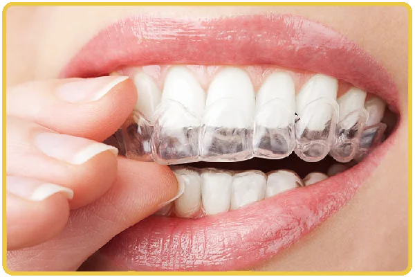Oral Splint