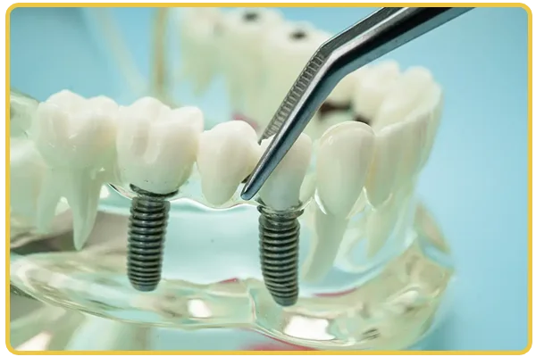 Dental Implants