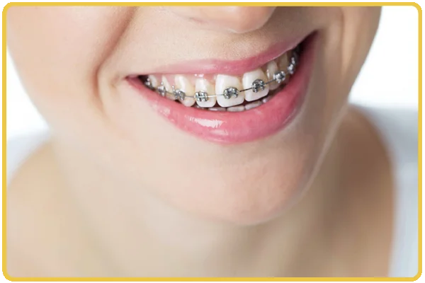 Braces and Aligners