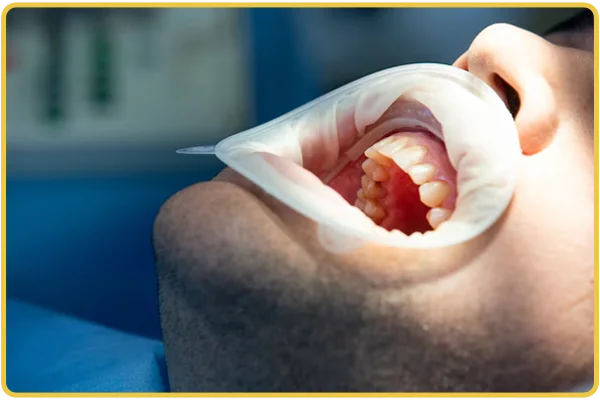 Gum Surgery
